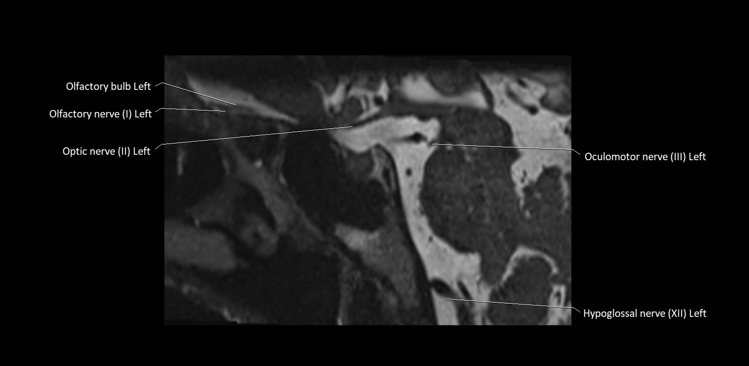 Cranial nerve sagittal anatomy MRI 3T image 28.webp